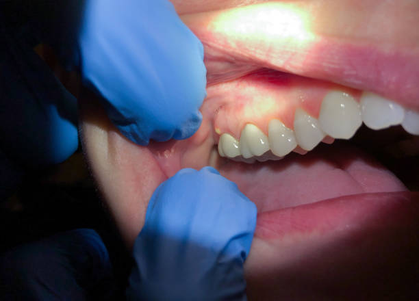 Best Tooth Infection Emergency Dentist  in Avon, MN